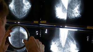 Breast cancer screening